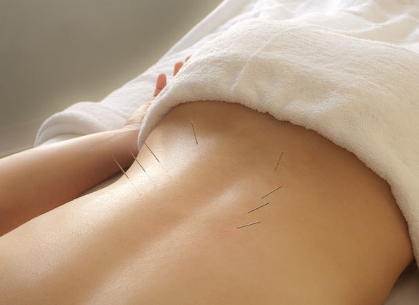 What are the differences between acupuncture and dry needling