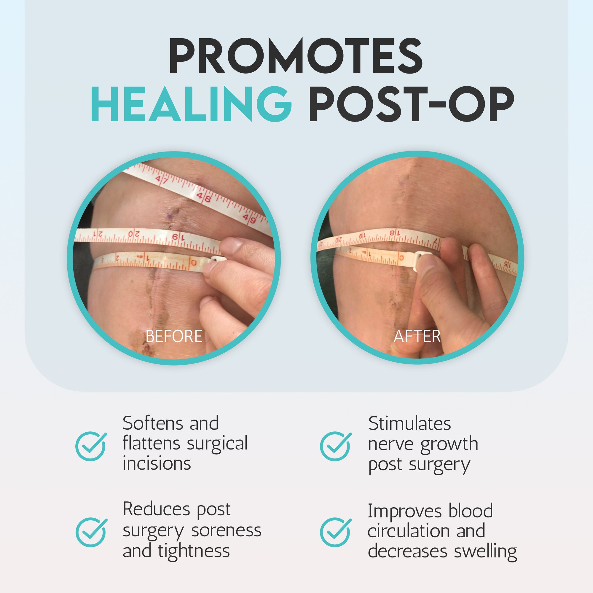 The Scar Roller - Post surgery incision Management The Scar Roller - Post surgery incision Management