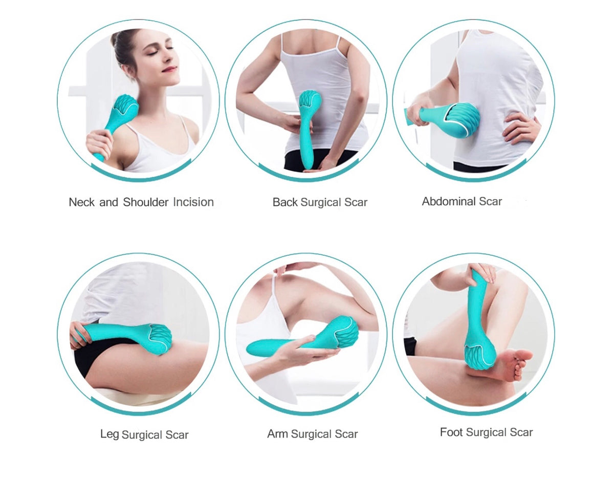 Scar Roller--Reduce Post Surgery Incision Swelling, Soreness and Tight
