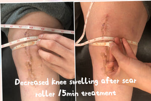 The Scar Roller - Pain Management Device